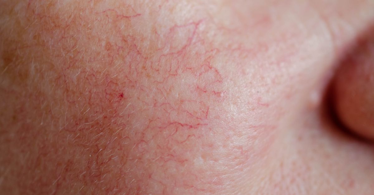 Sensitiv og reaktiv hud med synlige blodkar – de viktigste prinsippene for hudpleie