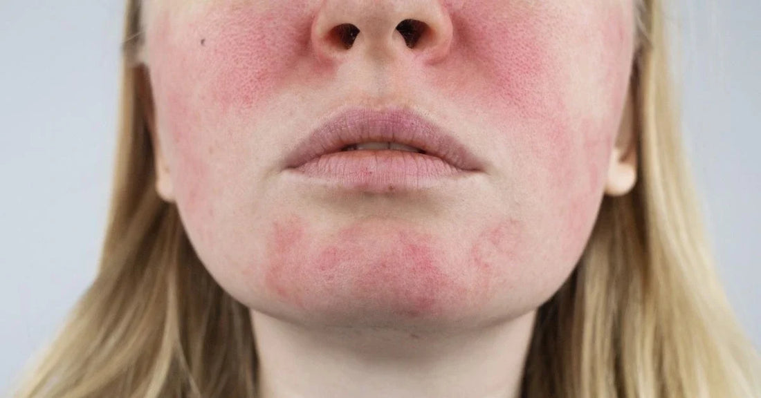 Beauty Plan for hud med rosacea