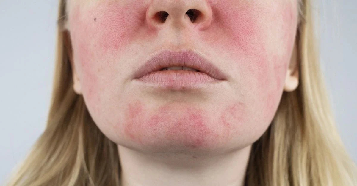 Beauty Plan for hud med rosacea